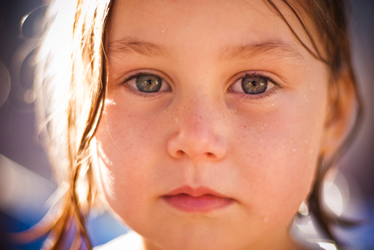 freckles